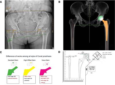 A novel method of manual positioning based on anatomical mark (shoulder-to-shoulder) to prevent postoperative leg-length discrepancy for femoral neck fractures in hip arthroplasty